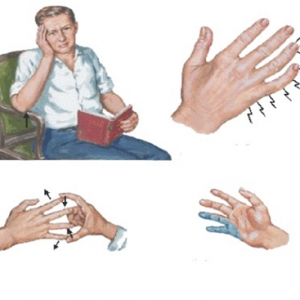 Rối loạn dây thần kinh trụ - Hình ảnh minh họa